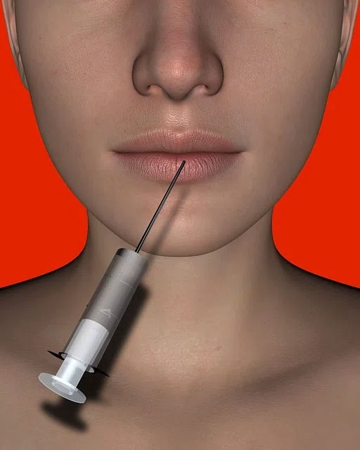injection de botox pour les rides des levres